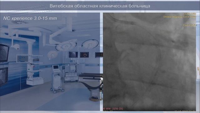 РЭВХ ВОКБ 027 Sould we routinely wiring \ predilate the SB смотреть онлайн