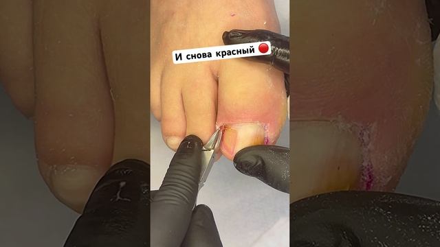 Помогу себе сам | советы от знатоков #вросшийноготь #грибокногтей #подногтем смотреть онлайн