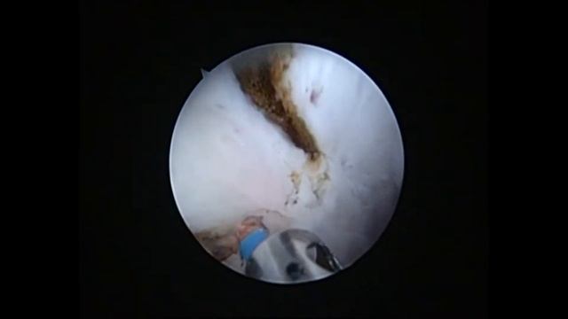L.H.H. Medical 980nm Diode Laser Stanch Effect Demonstration смотреть онлайн