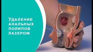 Удаление анальных полипов лазером