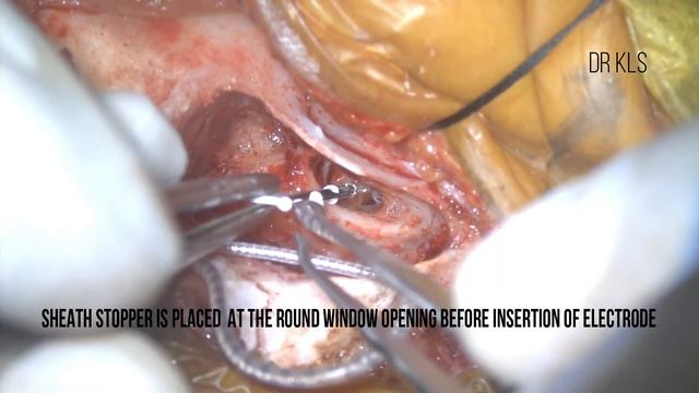 CI632 Cochlear Implant Surgery смотреть онлайн