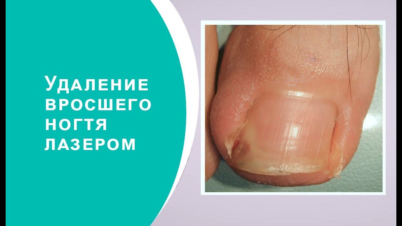 Удаление вросшего ногтя лазером смотреть онлайн