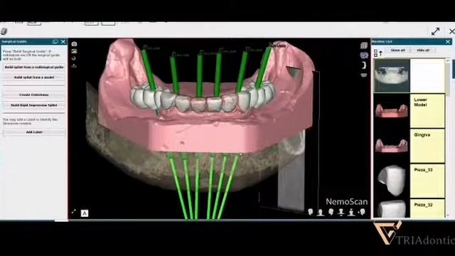 Guided bone reduction смотреть онлайн