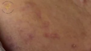 🔥 Выдавливание прыщей | Удаление и выдавливание прыщей и черных точек 2021 | Прыщи выдавливание #01