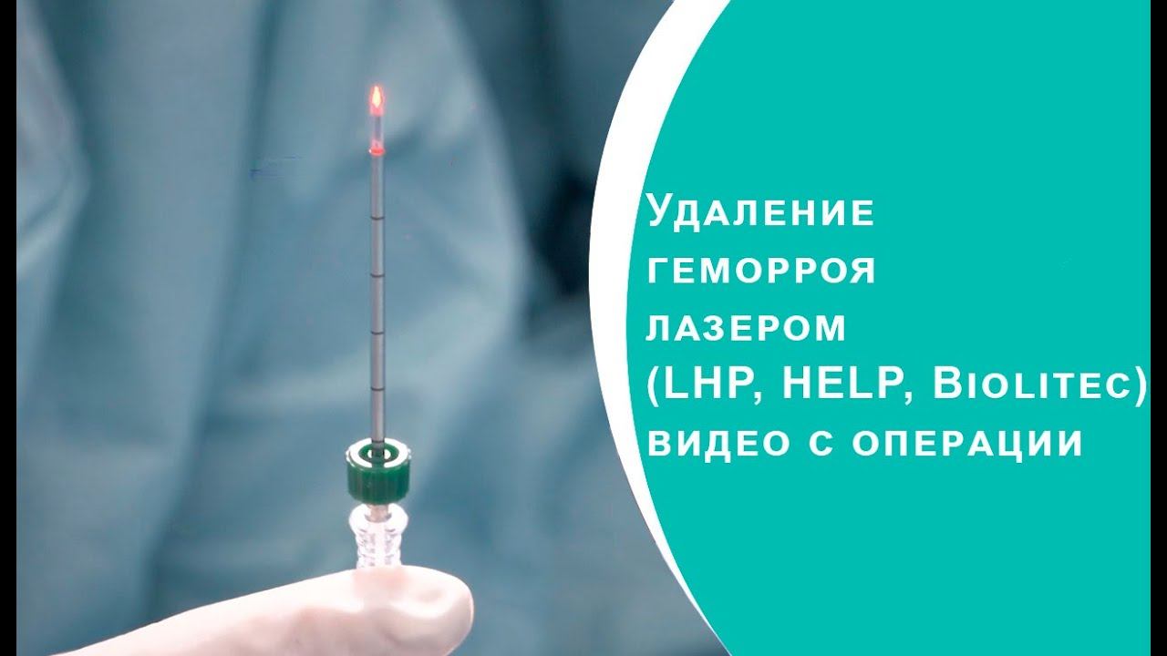 Удаление геморроя лазером (LHP, HELP, Biolitec) видео с операции