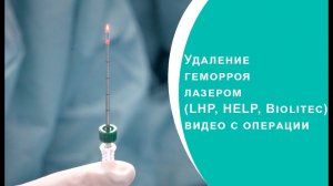 Удаление геморроя лазером (LHP, HELP, Biolitec) видео с операции