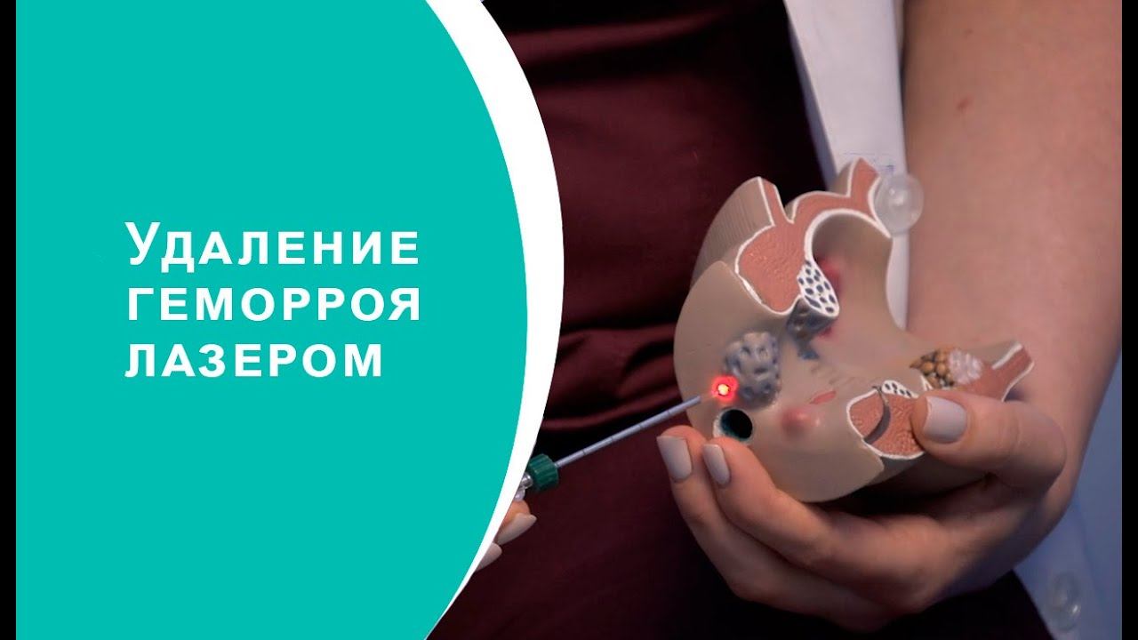 Удаление геморроя лазером