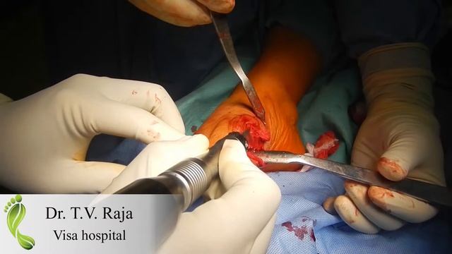 Dr T V Raja Hallux Valgus Surgery Visa Hospital Chennai смотреть онлайн