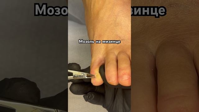 Увидеть отверстие после #мозоли #подология смотреть онлайн