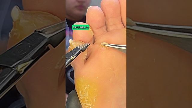 Лучший вариант удалить стержневую мозоль #подологмосква #мозоли смотреть онлайн