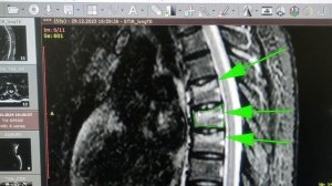 Перелом грудных позвонков как лечить Результат до и после