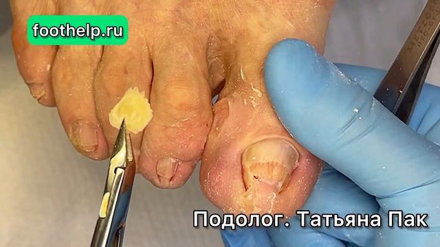 Мозоль в межпальцевом промежутке. Часть-2 смотреть онлайн