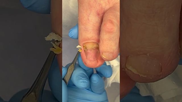 Распилить ноготь #подология #podologia смотреть онлайн