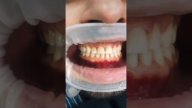 Ортодонт. Брекеты Damon. Лечение зубов. смотреть онлайн