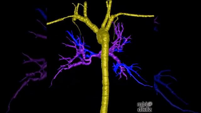 Imaging of aortopulmonary collateral arteries with high-resolution multidetector CT смотреть онлайн