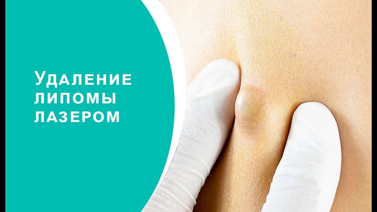 Удаление липомы лазером смотреть онлайн