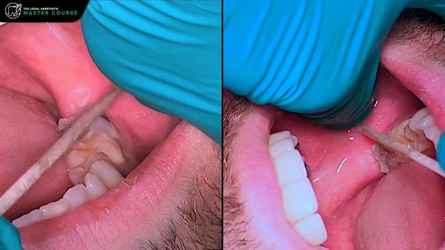 How To Do A Buccal Nerve Block | Online Dental Continuing Education | Local-Anesthetic.com смотреть онлайн