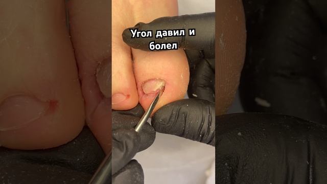 Четкий надрез ✂️давящего ногтя #вросшийноготь #подногтем #подологмосква смотреть онлайн