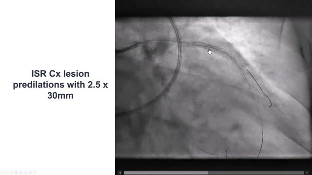 Case 155: Manual of PCI - Double DK crush смотреть онлайн