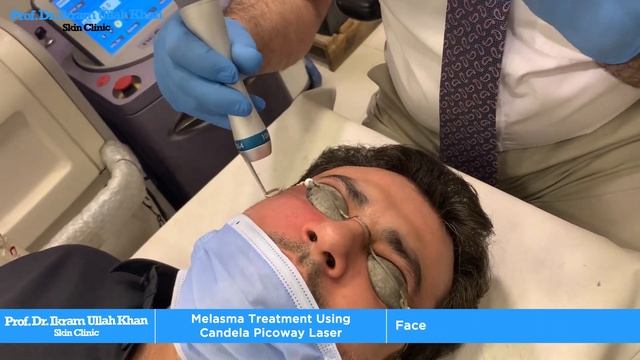 Melasma Be Gone: Candela PicoWay Laser Transformative Treatment! #melasmatreatment #lasertechnology смотреть онлайн