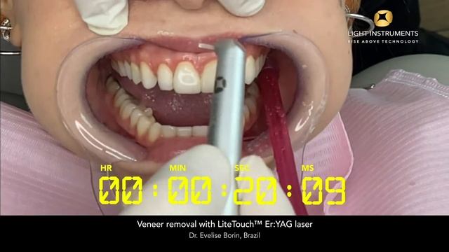 Veneer removal with LiteTouch™ Er:YAG laser смотреть онлайн