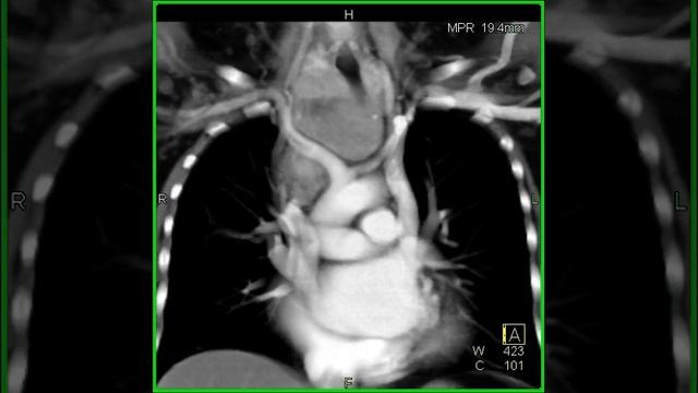 Cardiac: Persistent left superior vena cava emptying into coronary sinus (4 of 4) смотреть онлайн