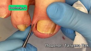 Вросший ноготь. Как проходит процедура у #подологтатьянапак