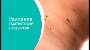 Удаление папиллом лазером