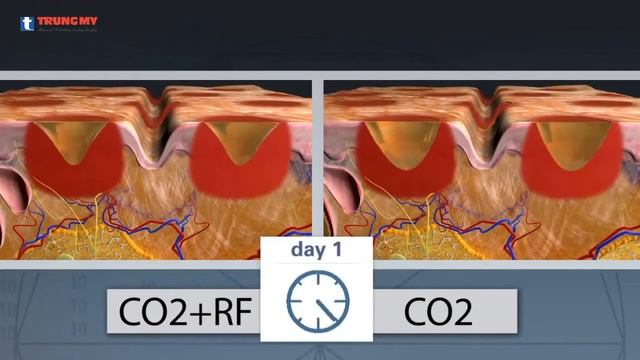 Công nghệ trị sẹo Smartxide DOT - Laser Fractional Co2 смотреть онлайн