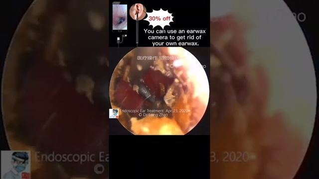 Best Ear Wax Removal & Extraction with Vacuum Remover 真空リムーバーによるにきびの除去と抽出 223 смотреть онлайн