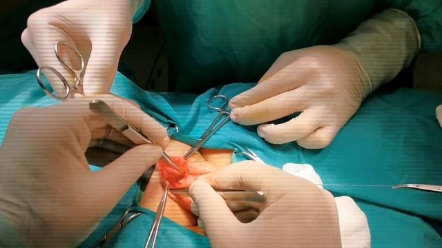 Buried Penis və ya Batıq Penis. смотреть онлайн