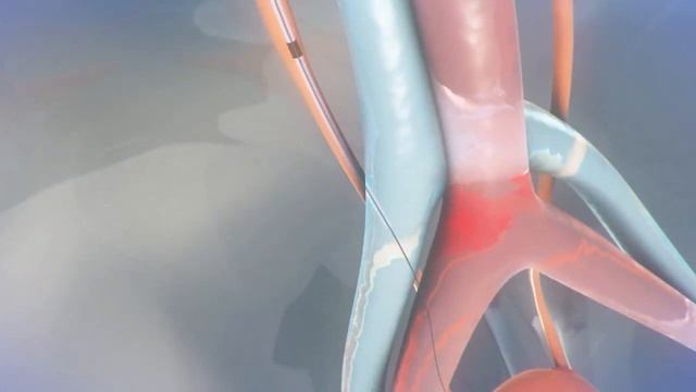 Expel™ Nephroureteral Stent Procedure Animated Demonstration смотреть онлайн