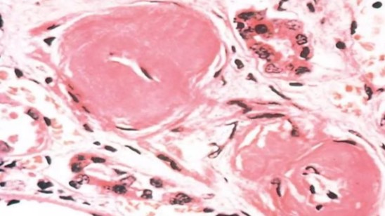 Патологическая анатомия атеросклероза и артериальных гипертензий смотреть онлайн