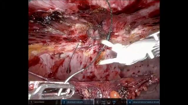 RAL Umbilical hernia repair смотреть онлайн