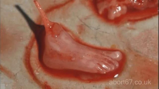 Real Abortion video смотреть онлайн