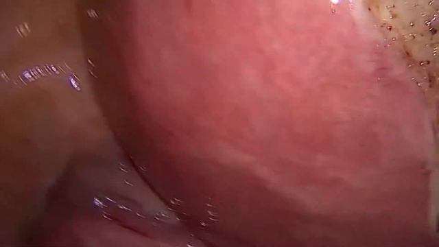 MIOMECTOMIA VLP смотреть онлайн