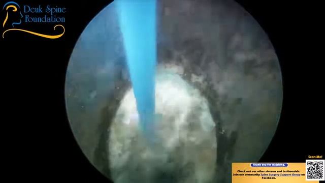 4 Level Lumbar Spine Laser Disc Repair L2-3, L3-4, L4-5, L5-S1 - DLDR W/ Live Q&A смотреть онлайн