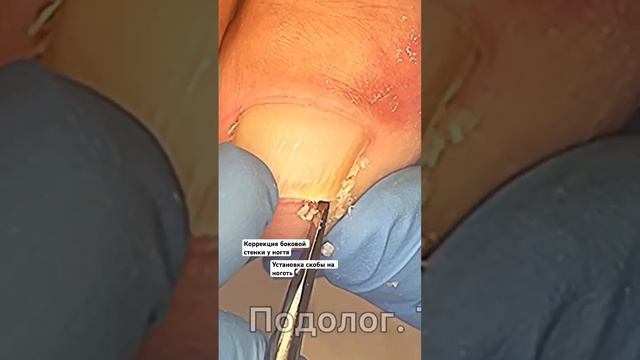 Когда боковые стенки ногтя скрутились во внутрь #вросшийноготь #подологмосква смотреть онлайн