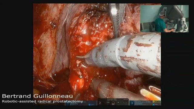 Bertrand Guillonneau - Robotic-assisted radical prostatectomy (RARP) смотреть онлайн