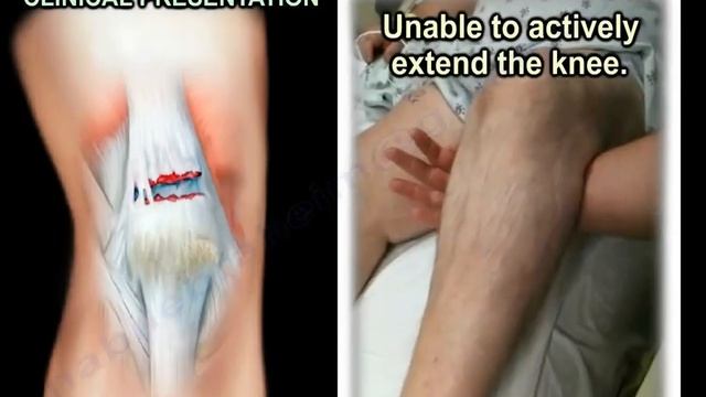 Quadriceps Tendon Rupture - Everything You Need To Know - Dr. Nabil Ebraheim смотреть онлайн