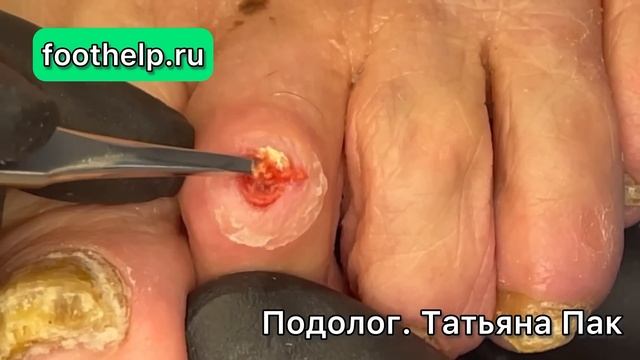 Болезненная мозоль на верхушке искривленного сустава. Удаление мозоли смотреть онлайн