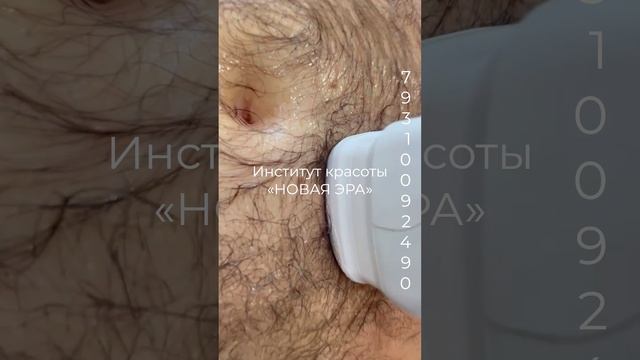 Косметология Новая Эра, процедура Липосоникс смотреть онлайн