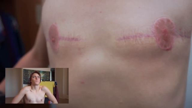 CICA-CARE Silicone Gel Sheet Scar Treatment Review