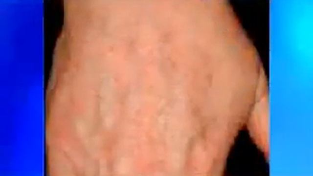 Gentlemax Pro Laser Treatments (PART 3) смотреть онлайн