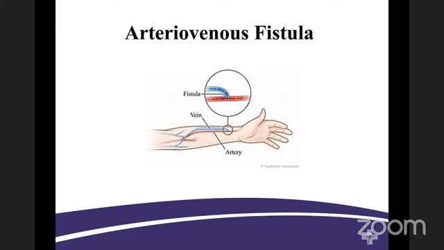 Chronic Kidney Disease and Options for Advanced Kidney Disease with Advocate Health смотреть онлайн