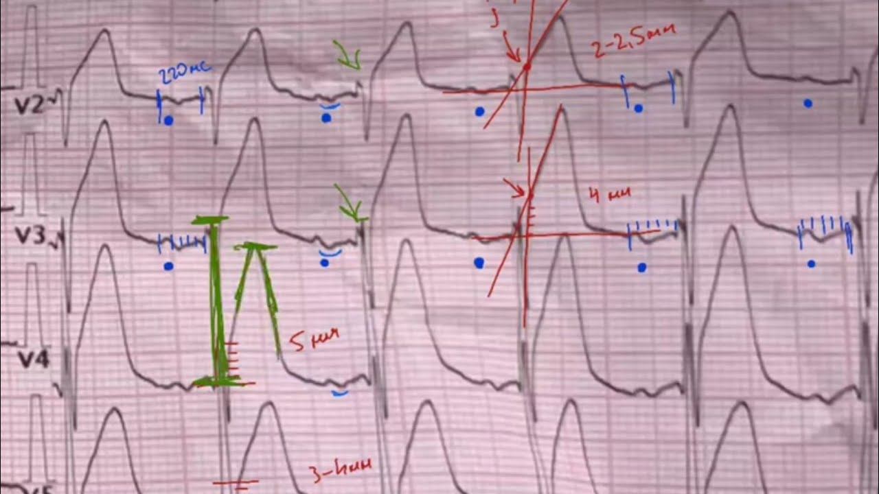 Передний распространённый ИМ
