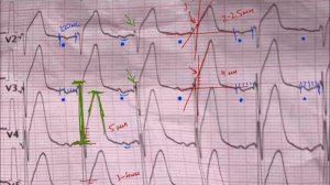 Передний распространённый ИМ