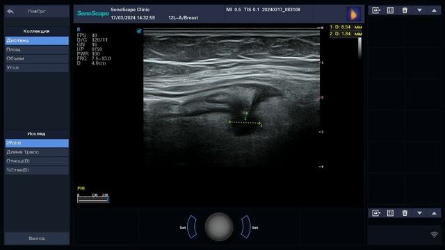 Как выглядит ДИВЕРТИКУЛИТ на УЗИ? смотреть онлайн