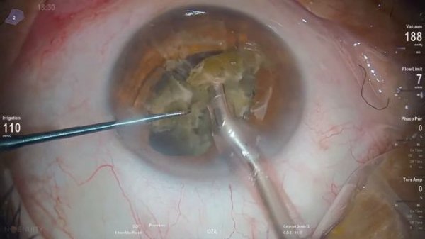 Dr.Stanimir Troshev Cataract Surgery Livestream- Lux Smart IOL