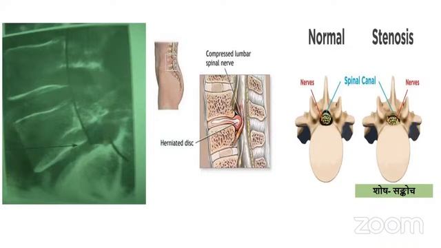KSGAMOA WEBINAR 111: COMMON JOINT DISEASES DIAGNOSIS AND OPD MANAGEMENT: DR. PAVANA J MD(AY) смотреть онлайн